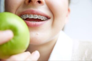 5 Foods to Avoid With Braces