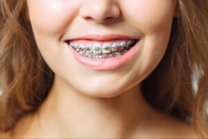 5 Foods to Avoid With Braces